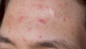 Congratulations! Your Fungal Acne Is About To Stop Being Relevant