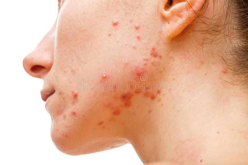Congratulations! Your Fungal Acne Is About To Stop Being Relevant