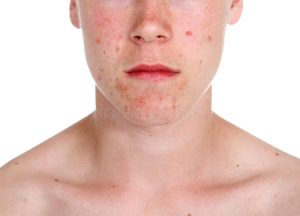 Congratulations! Your Fungal Acne Is About To Stop Being Relevant